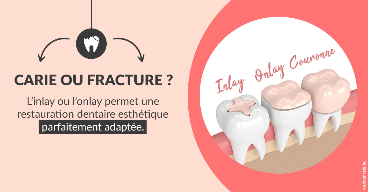 https://dr-gaillard-frederique.chirurgiens-dentistes.fr/T2 2023 - Carie ou fracture 2