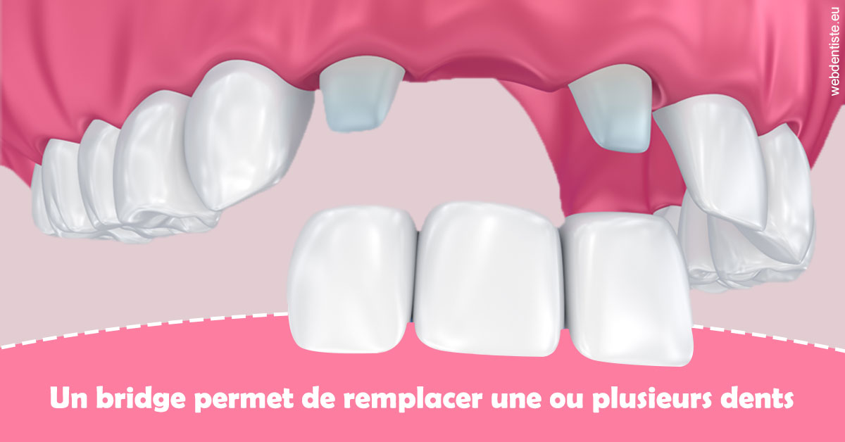 https://dr-gaillard-frederique.chirurgiens-dentistes.fr/Bridge remplacer dents 2