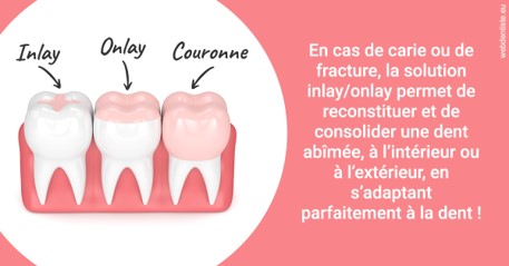 https://dr-gaillard-frederique.chirurgiens-dentistes.fr/L'INLAY ou l'ONLAY 2