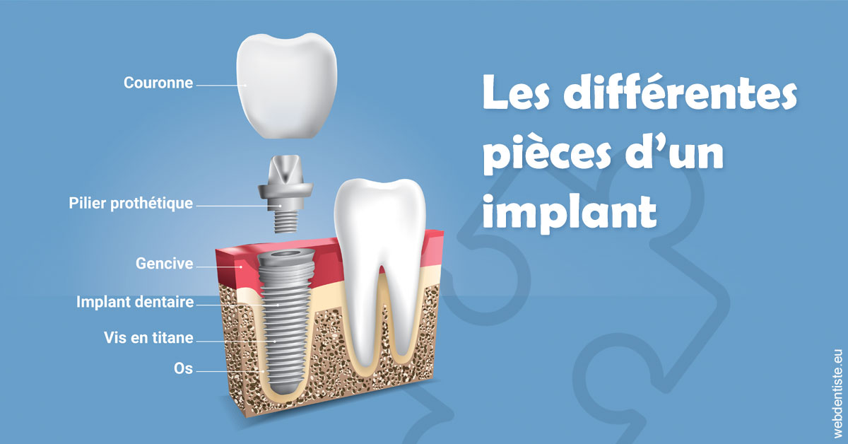 https://dr-gaillard-frederique.chirurgiens-dentistes.fr/Les différentes pièces d’un implant 1