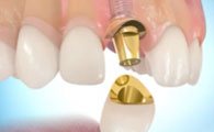 Prothese-dentaire-sur-implant-147